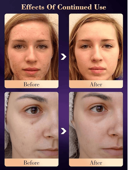 LED Hydrating light therapy mask